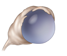Torbiel funkcjonalna.