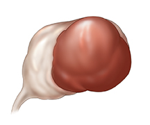 Guz gruczolisty.