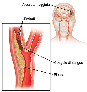 Coagulo di sangue che blocca l’arteria carotide ed emboli che si staccano dal coagulo. L’inserto mostra danni al cervello.