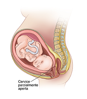 Vista laterale del feto nell’utero che mostra la cervice che inizia ad assottigliarsi e ad aprirsi durante il travaglio pretermine.