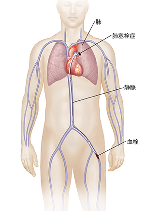 肺塞栓症を引き起こす、脚の静脈から肺への血栓の経路を示す矢印の付いた男性像の正面図。