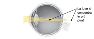 Sezione trasversale di un occhio con la luce concentrata su più punti.