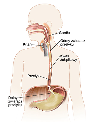 Zarys kobiety pokazujący jamę ustną, przełyk i żołądek. Strzałki pokazują przepływ kwasu żołądkowego w górę przełyku i drażniącego tył gardła.