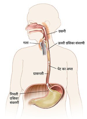 मुँह, ग्रासनली और पेट को दर्शाते हुए महिला की रूपरेखा। तीर दर्शाते हैं कि पेट का अम्ल गले के पीछे जलन करने के लिए ऊपर ग्रासनली में प्रवाहित हो रहा है।