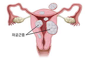 세 가지 유형의 자궁근종을 보여 주는 자궁의 전면 단면도.