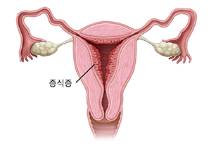 자궁내막증식증을 보여주는 여성 생식관의 전면 단면도.