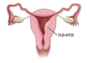 자궁 내 암을 보여주는 여성 생식관의 전면 단면도.