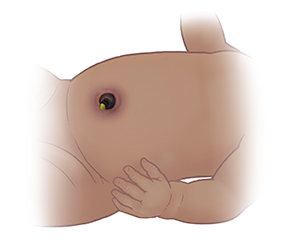 臍帯断端の周囲に炎症を起こした赤ちゃんの正面図。