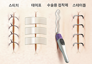 봉합사, 스테리 스트립, 수술용 접착제 및 스테이플이 있는 봉합을 나타내는 4개의 절개 부위.