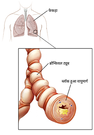 श्वासनली और फेफड़ों को दर्शाने वाली मानव छाती की रूपरेखा। प्रदाह और बलग़म बनना दर्शाते हुए ब्रोन्कियल ट्यूब का क्लोज़अप।