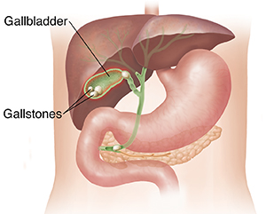 Outline of torso showing liver and stomach with cross section of gallbladder with stones.