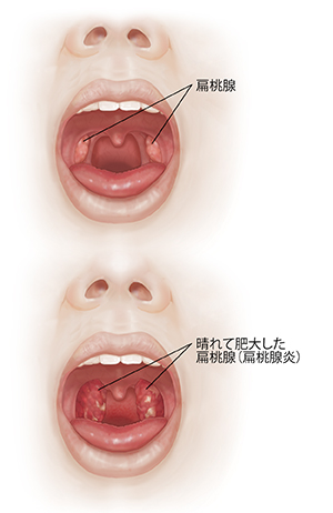 口腔と扁桃腺の喉の炎症と扁桃腺の肥大を比較した、口を開けた状態の顔の正面図。