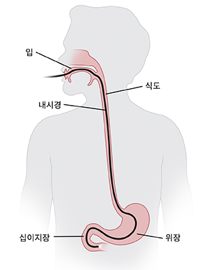 입과 식도에 내시경이 삽입된 머리와 몸통의 대략적 모습. 내시경은 소장의 첫 번째 부분에서 끝납니다.