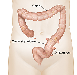 Vista frontale di un colon con sacche di diverticoli nella parte inferiore.