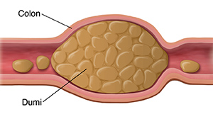 Cross section ng colon na ipinakikita ang matigas na dumi sa loob.