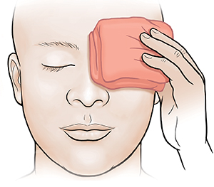 Un adulto sostiene una compresa tibia en el ojo.
