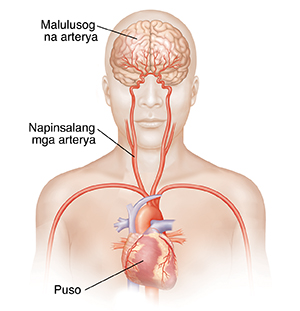 Harapang kuha ang ulo at itaas na katawan na ipinakikita ang mga carotid artery (ang pangunahing mga ugat ng dugo sa leeg) at utak.