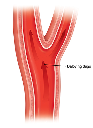 Cross section ng malusog na carotid artery na ipinakikita ang pagdaloy ng dugo.
