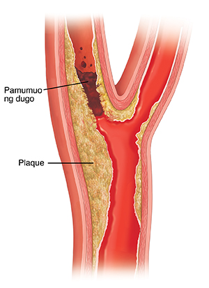 Cross section ng carotid artery na ipinakikita ang pamumuo ng plaque at blood clot (pamumuo ng dugo).