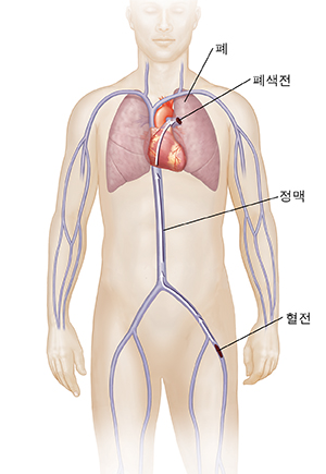 혈전이 다리 정맥에서 폐로 이동해 폐색전증을 일으키는 경로를 가리키는 화살표가 있는 남성 모습의 전면도.