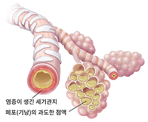 폐렴으로 인해 점액이 쌓이고 염증이 생긴 세기관지와 폐포낭.
