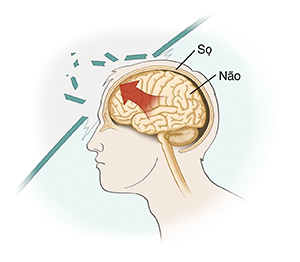Hình chiếu cạnh của đầu thể hiện chấn thương não.