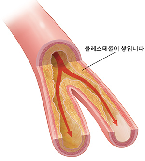 플라크가 쌓여 있고 혈류 제한되고 있는 동맥의 단면도.