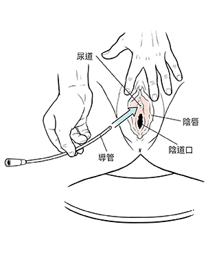 外陰特寫，顯示將雙手將導管插入尿道口。