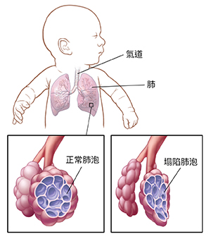 嬰兒頭部轉向一側,顯示氣道和肺部。氣道和正常肺泡特寫。氣道特寫和塌陷肺泡。