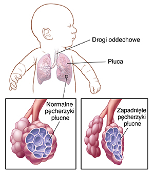 Niemowlę z głową obróconą na bok z widocznymi drogami oddechowymi i płucami. Zbliżenie dróg oddechowych i prawidłowych pęcherzyków płucnych. Zbliżenie dróg oddechowych i zapadniętych pęcherzyków płucnych.
