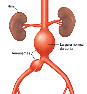 Vista frontal da aorta abdominal com aneurismas. A linha pontilhada mostra a largura normal da aorta.