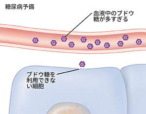 前糖尿病で血糖値が非常に高くなった血管と細胞の断面図。