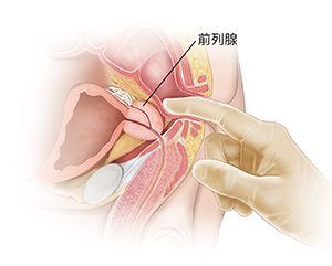 顯示肛門指診的男性骨盆器官側視圖。