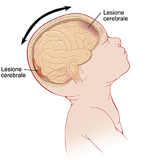 Vista laterale di un neonato con il capo inclinato all’indietro con il cervello in evidenza. Le frecce indicano la testa che si muove in avanti e indietro e le lesioni nella parte anteriore e posteriore del cervello.