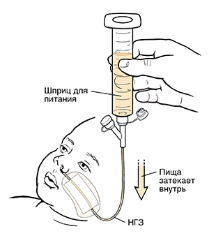 Рука, держащая шприц, наполненный жидким питанием, который введен в назогастральный зонд младенца. Питание течет из шприца в зонд.