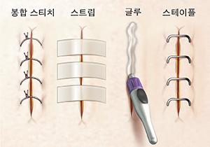 봉합 스티치, 스테리스트립, 글루 및 스테이플을 보여주는 절개부 클로즈업.