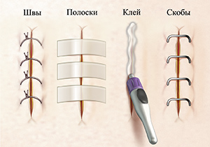Крупный план разрезов: швы, стерильные полоски, клей и скобы.